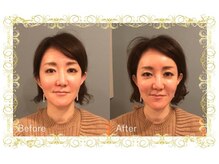 レメディ/再生美容鍼コース