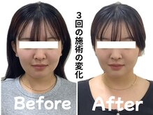 むくみ・たるみ・小顔ケア◎！3回でここまで変わる美容鍼