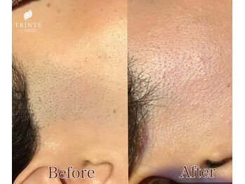トリンテ バイ フェース(TRINTE by FAITH)/【もみあげ脱毛】途中経過