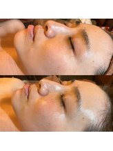 シャラ(shara)/幹細胞ハーブピーリングでツヤ肌