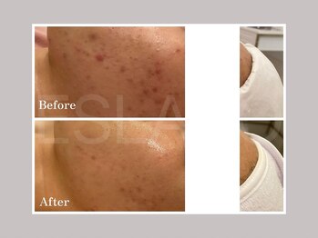 エスラボ オオサカ 心斎橋/韓国ピーリング組合せ