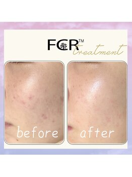 シャルム ココ 八尾店(Charme coco)/ニキビケア　１回目