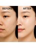 【くすみ・毛穴・ニキビ】REVI 陶肌トリートメント