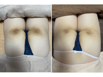 ダリア/ヒップにもハーブピーリング◎