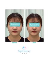 シンメトリー 池袋店/小顔矯正ビフォーアフター