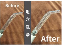 エルモーサ(HERMOSA)の雰囲気（純水のみを使用♪お肌に優しいのに効果大！洗浄&吸引で汚れオフ）