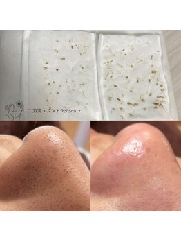 ジュメイラ(Jumeirah)の写真/【大人気◎肌質改善】毛穴エクストラクションで毛穴ケア・引き締め、圧倒的ツヤ肌が叶うフェイシャル☆