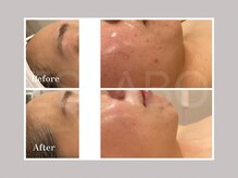 エスラボ オオサカ 心斎橋/洗浄×カーボキシー炭酸パック