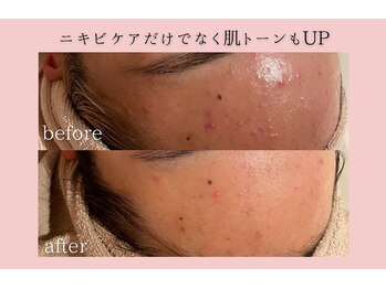 フォーウーマン(for woman)/施術3回の効果