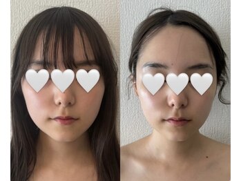 モア 吉祥寺(MORE.)/小顔リフト6回Before after