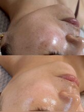 モアナ(Moana)/【シミ改善/シミケア】