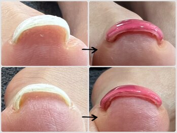 アンドネイル(+ and Nail)の写真/どこに行っても良くならなかった方に試してほしい!特許取得済ジェルで本格巻き爪ケア+フットネイル*立川駅