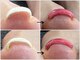 アンドネイル(+ and Nail)の写真/どこに行っても良くならなかった方に試してほしい!特許取得済ジェルで本格巻き爪ケア+フットネイル*立川駅
