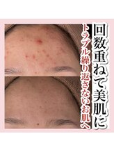 アルムダアクア 天王寺店(Aleumda AQUA)/ハーブピーリング/大阪/天王寺