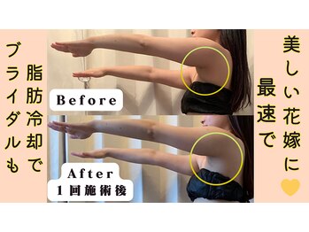 レパード/二の腕や脇のお肉もスッキリ!