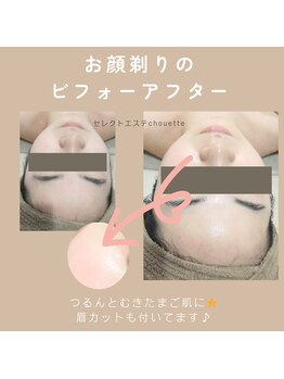 セレクトエステ シュエット(chouette)/お顔そりbefore after