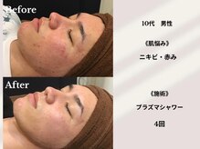 ティアラ 葛西店(TIARA)/10代男性　4回施術