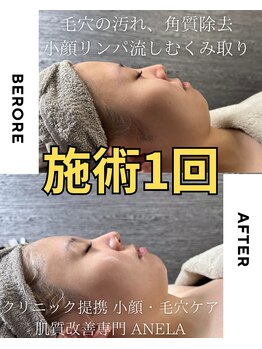 アネラ(ANELA)/即効果実感　1
