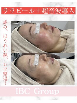 IBC 上大岡店/ツヤ肌に!ララピール