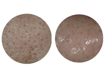 メナードフェイシャルサロン 山幹南武庫/毛穴の汚れがお悩みのお客様！