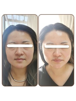 アンティクイーン(Antiqueen)/リフトアップ、ホワイトニング