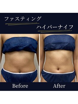 ハリルル 併設 GLケンタ鍼灸整骨院(HARILULU)/腸活との組み合わせで！