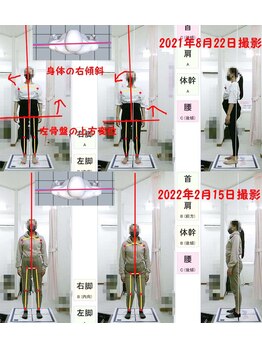 姫路なごみ整体院 なごみ鍼灸院/改善例（反り腰・産後腰痛）