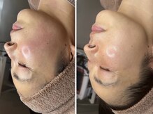 ラヴィオス(RAVIOS)/ハーブピーリング/ララピール