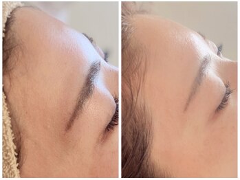 メディカルエース(MedicalAce)/脂肪増殖