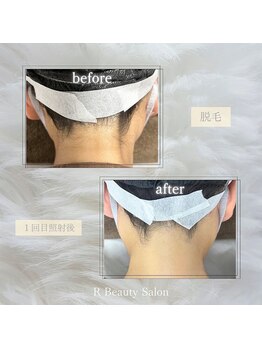 アールビューティーサロン(R Beauty Salon)/うなじ脱毛