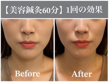 サンクエール 代官山鍼灸院(CINQ AILES)/美容鍼　くいしばり・小顔・エラ