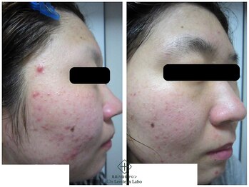 アンレミューラボ(Un Lemieux Labo)/ニキビ、凸凹跡改善