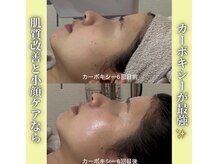 ハニエル(Haniel)/カーボキシー症例