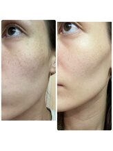 ウナ デ リンゴル 恵比寿店(UNA de Ringol)/愛されすっぴん肌へ！