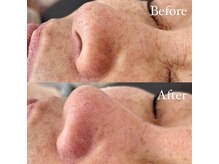 アイラッシュサロンアールツー(eyelash salon R2)/毛穴ハイドロピーリング