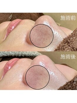 エクラ バイ シャンリィ(eclat by shanLy)/毛穴革命