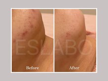 エスラボ オオサカ 心斎橋/韓国ピーリング組合せ