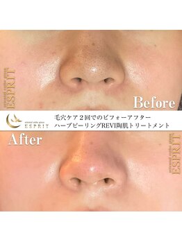 エスプリ 銀座店/ハーブピーリング銀座