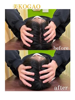 須磨わだち整骨院/美小顔矯正ビフォーアフター