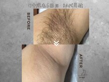ル シャの雰囲気（夏に向けてまだ間に合う！ムレない臭わないツルツルなワキに！）