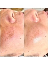 ジン フォー ユアビューティー(JIN for your beauty)/施術経過