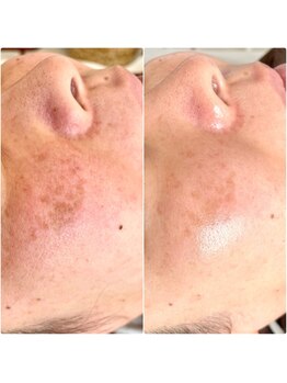 ジン フォー ユアビューティー(JIN for your beauty)/施術経過