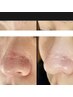 【ムダ毛/角栓・角質除去】フェイシャルWAX脱毛＋毛穴引き締め美容液導入♪