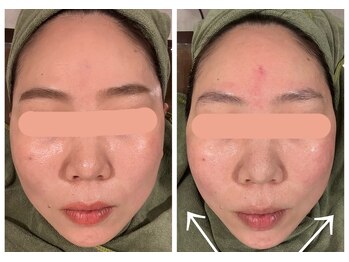 だれでもエステ 北浜店/ハイパーナイフ小顔術の効果！！