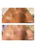 【当店人気No.1♪】全身脱毛ビタミン導入付［全身+顔+VIO］¥22000⇒