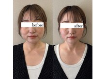 美容鍼×小顔矯正で理想の小顔に！フェイスラインが激変します◎