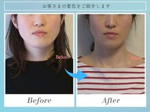 整体いったんとこの雰囲気(毎朝鏡を見るのが嬉しくなった【フルコース】5回/30代/エラ改善)