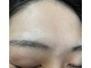 リノ(Lino)/カーボンピーリング2回終了後