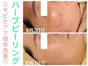 エリン(ERIN)/ハーブピーリング　２回目