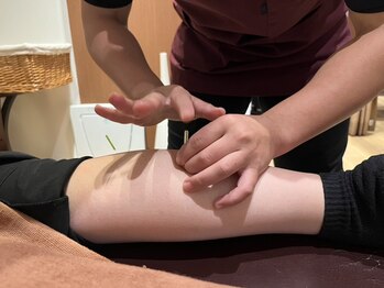 りはりの写真/【スタッフは全員国家資格保持者】鍼施術が初めての方にもおススメです◎自律神経を整え身体をスッキリ♪